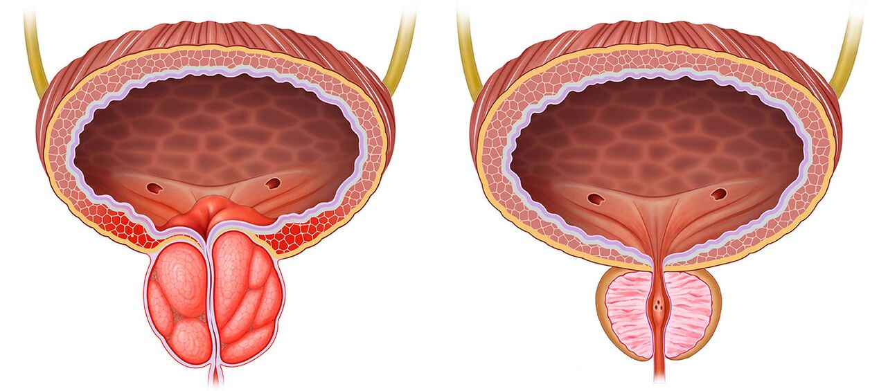 Zanícená a zdravá prostata po použití předběžných tobolek