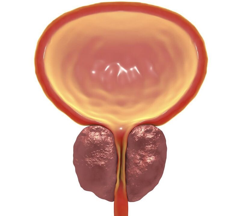zánět chronické prostatitidy