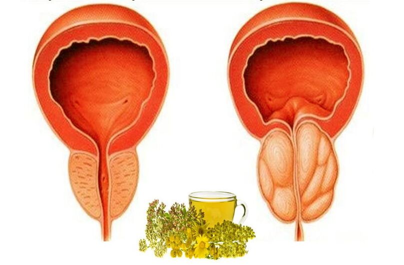 Zdravá a bolest prostaty