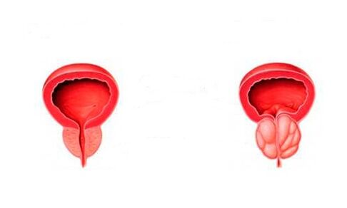 zdravá a zanícená prostata s prostatitidou